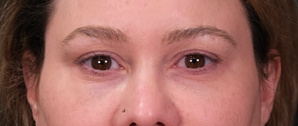 Blepharoplasty Before, Female 40 - 1533