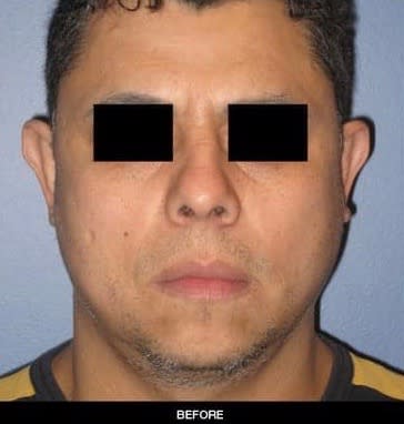 Ear Pinning Solutions Before, Male 33 - 2455