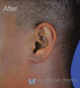 Earlobe Restoration Solutions After, Male 30 - 1855