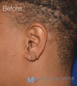 Earlobe Restoration Solutions Before, Male 30 - 1855