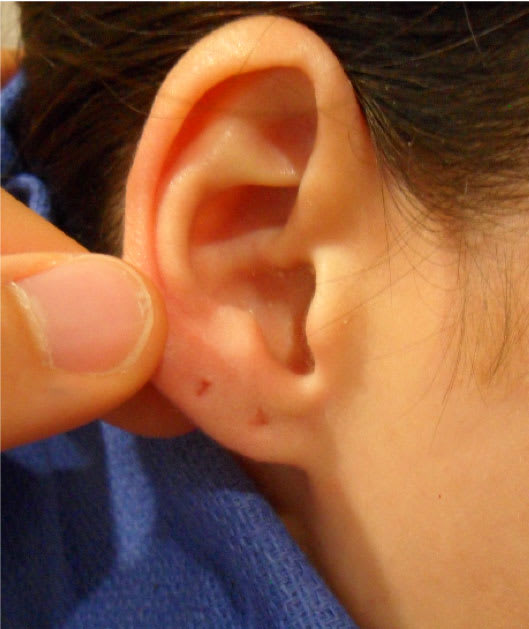 Earlobe Restoration Solutions After, Female 21 - 2619