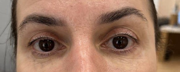 Laser Skin Resurfacing After, Female 45 - 4096