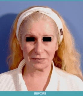 Brow Lift Before, Female 53 - 2460