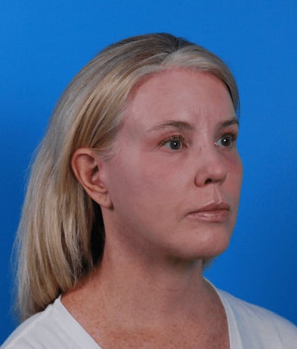 Facelift After, Female 53 - 2353