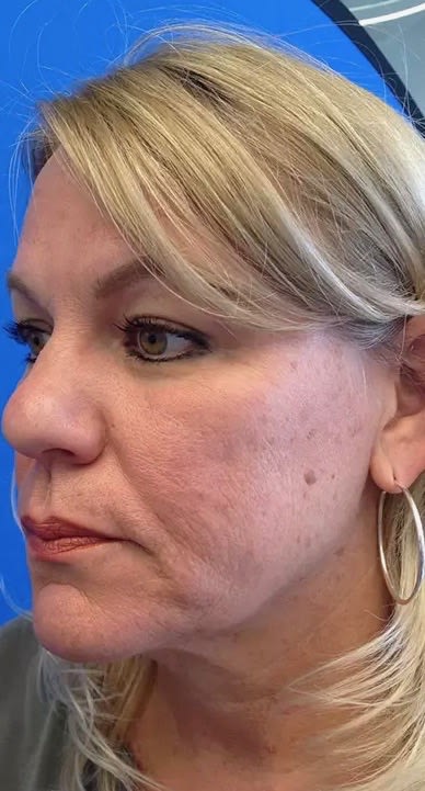 Facelift Before, Female 50 - 2837