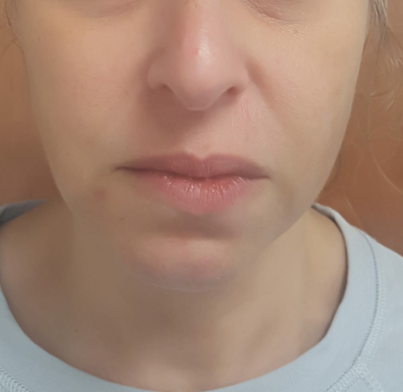 Cheek Augmentation & Cheek Reduction Solutions After, Female 50 - 3812