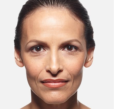 Dermal Fillers & Injectables Before, Female 35 - 4857