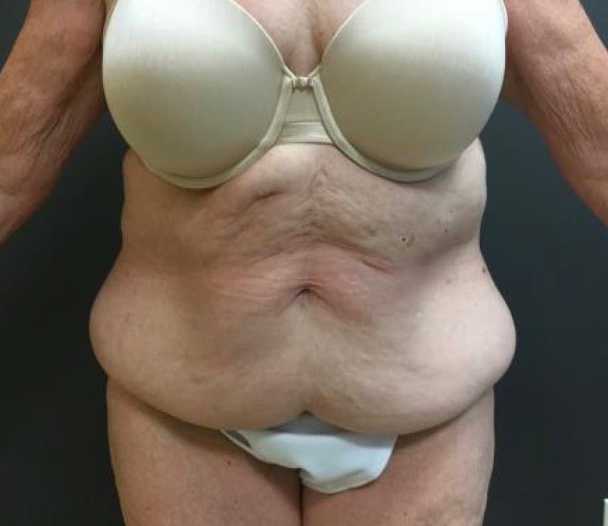 Mommy Makeover Solutions Before, Female 51 - 2290