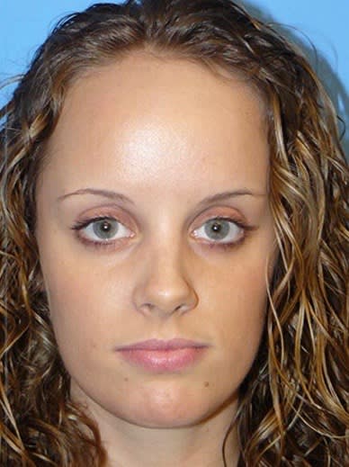 Forehead Reduction Before, Female 19 - 2372