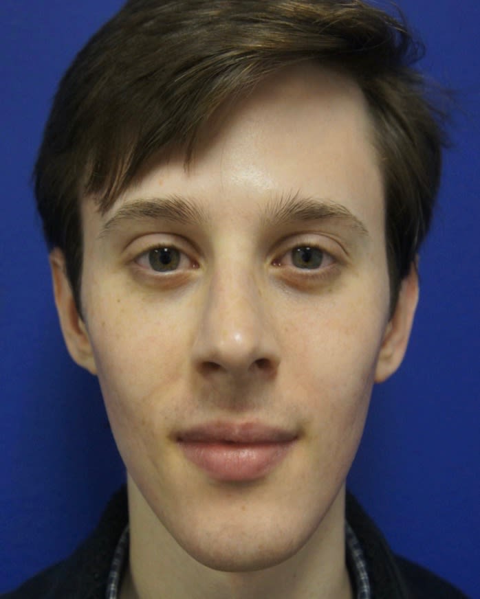 Fraxel® Repair After, Male 23 - 1982