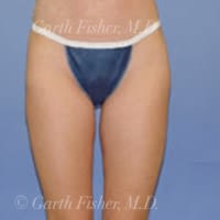 Body Contouring Solutions After, Female 32 - 4314