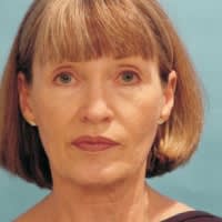 Facelift Before, Female 64 - 4308