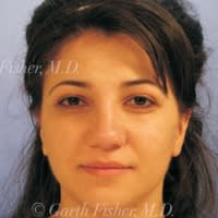 Rhinoplasty After, Female 42 - 4309
