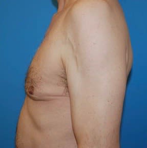 Male Breast Reduction (Gynecomastia Surgery) Before, Male 58 - 2610