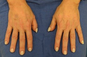 Radiesse® After, Female 52 - 2612