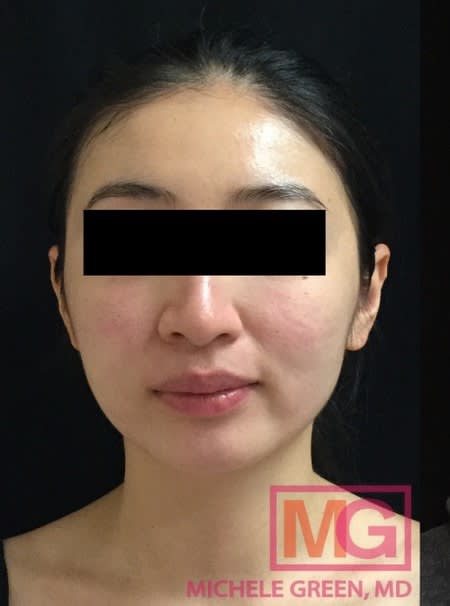 Acne Scar Treatment Before, Female 29 - 1098