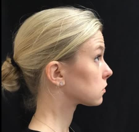 Botox Before, Female 32 - 1099