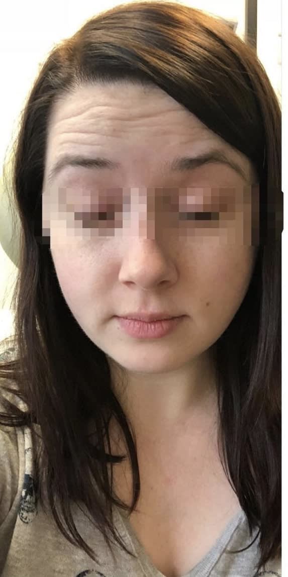 Botox Before, Female 28 - 1167
