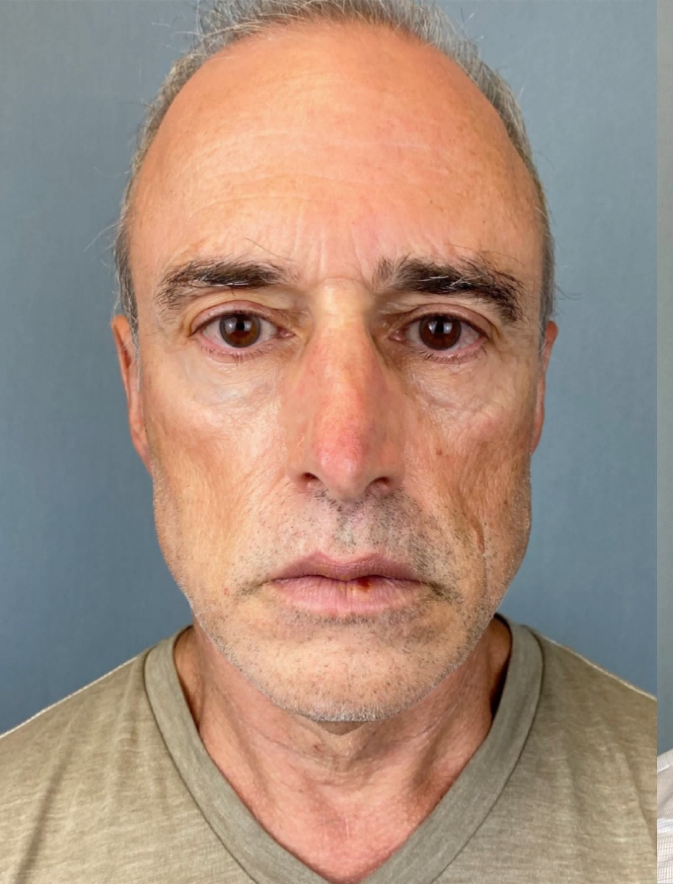 Neck Lift Before, Male 53 - 1301