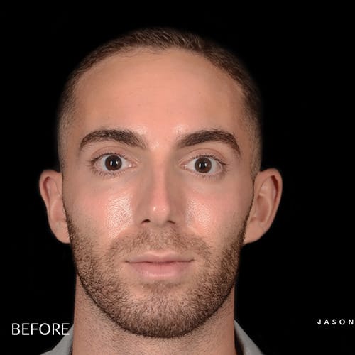 Dermal Fillers & Injectables Before, Male 32 - 1051