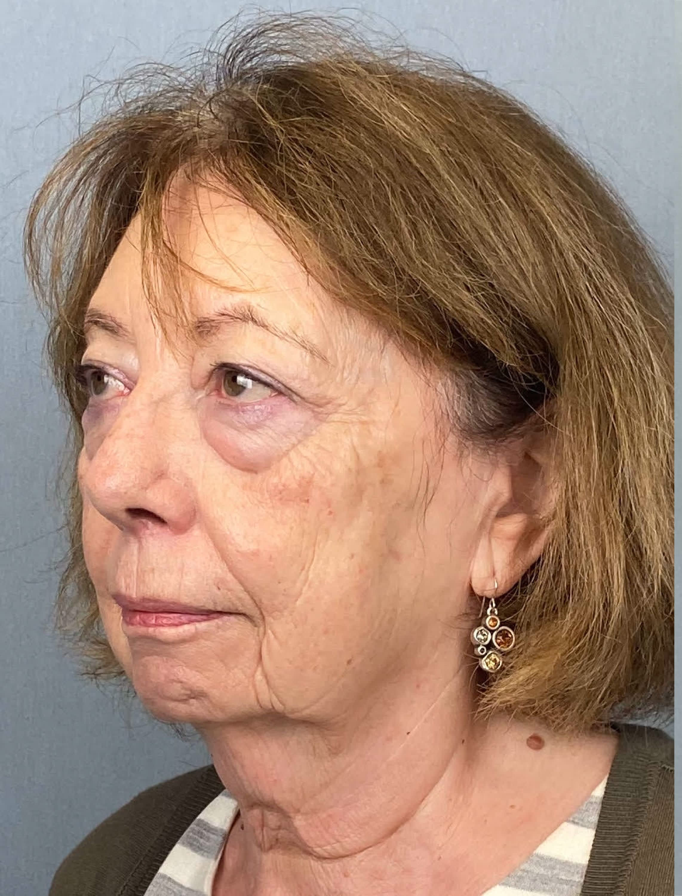 Facelift Before, Female 65 - 1309