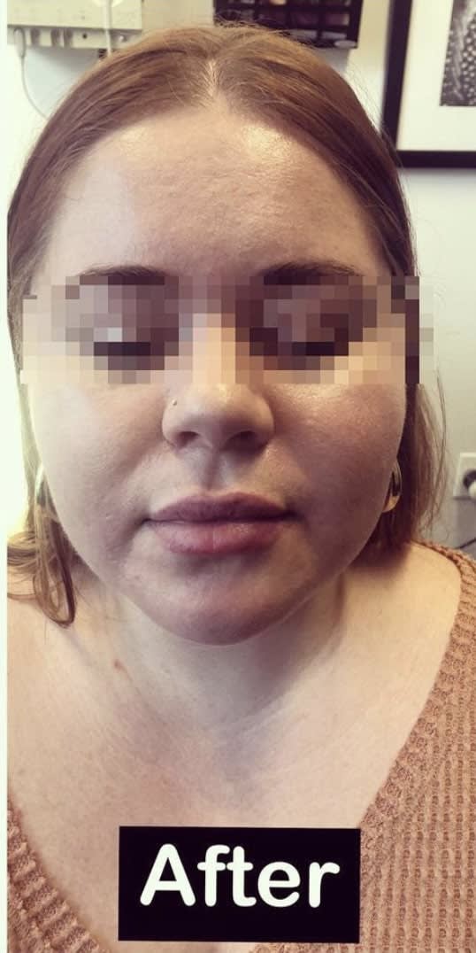 Lip Augmentation and Injections After, Female 25 - 1166