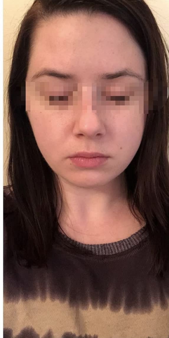 Botox After, Female 28 - 1167