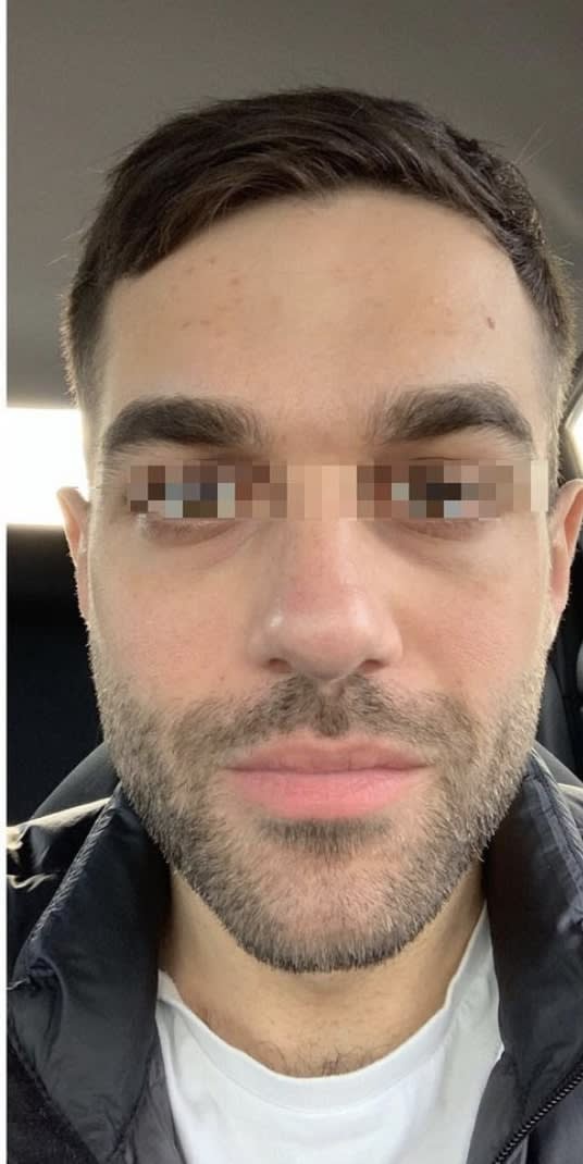 Under Eye Filler After, Male 32 - 1168