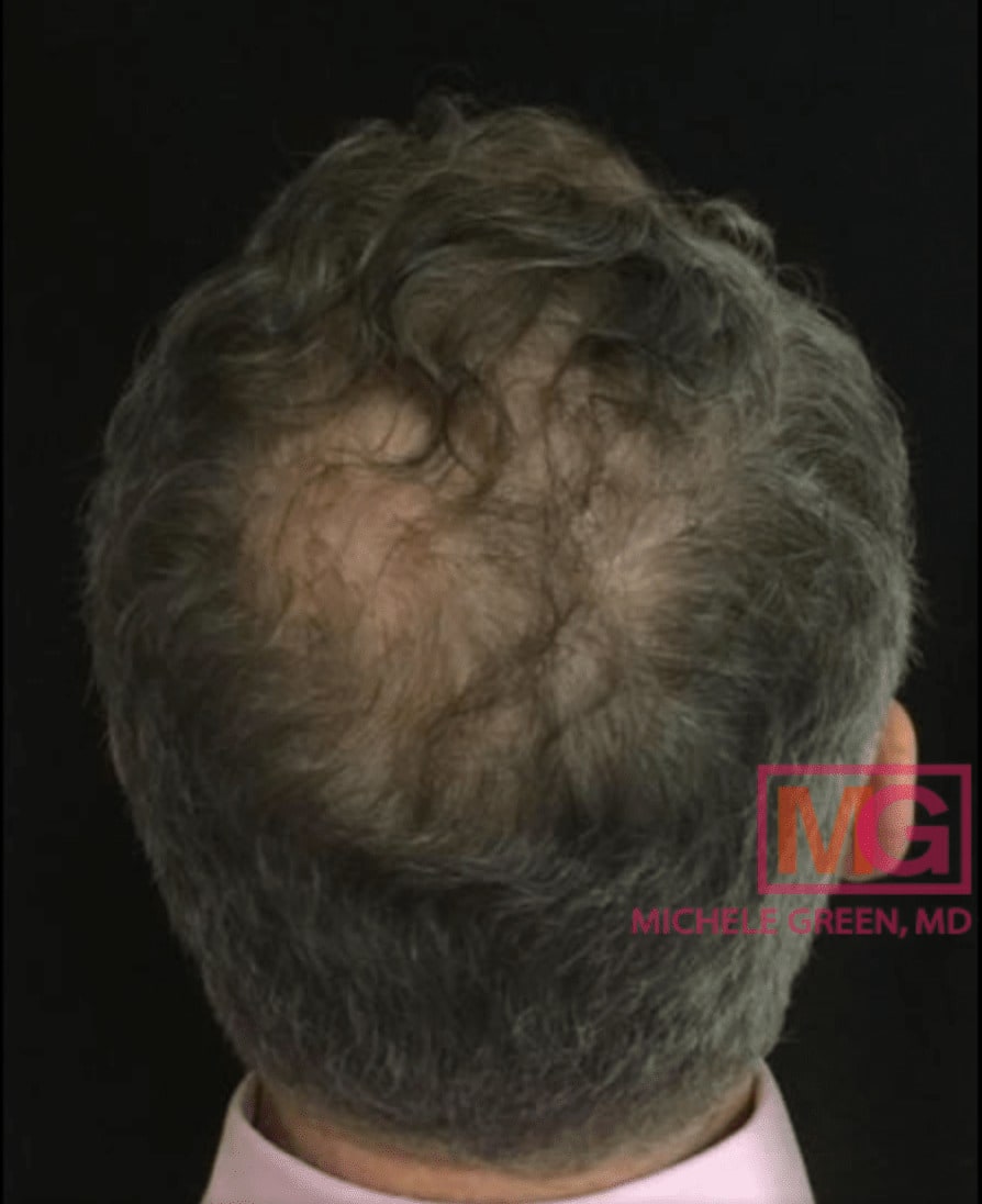 Platelet-Rich Plasma (PRP) Injections for Hair Loss After, Male 48 - 1110