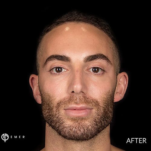 Dermal Fillers & Injectables After, Male 32 - 1051