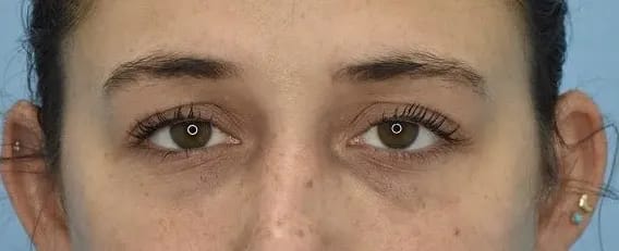 Under Eye Filler After, Female 25 - 484