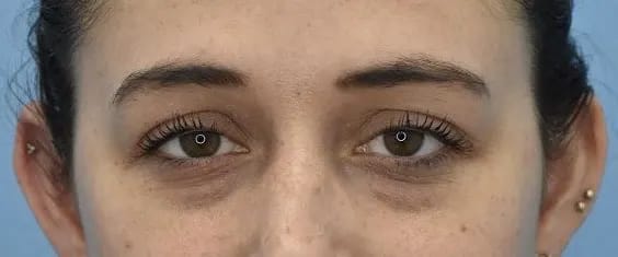 Under Eye Filler Before, Female 25 - 484