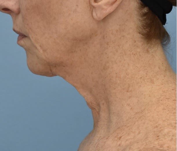 PDO Thread Lift Before, Female 59 - 485