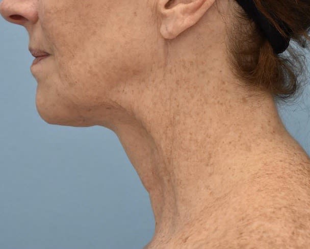 PDO Thread Lift After, Female 59 - 485