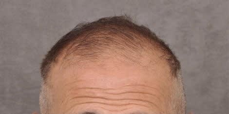 Hair Transplant Before, Male 68 - 4653