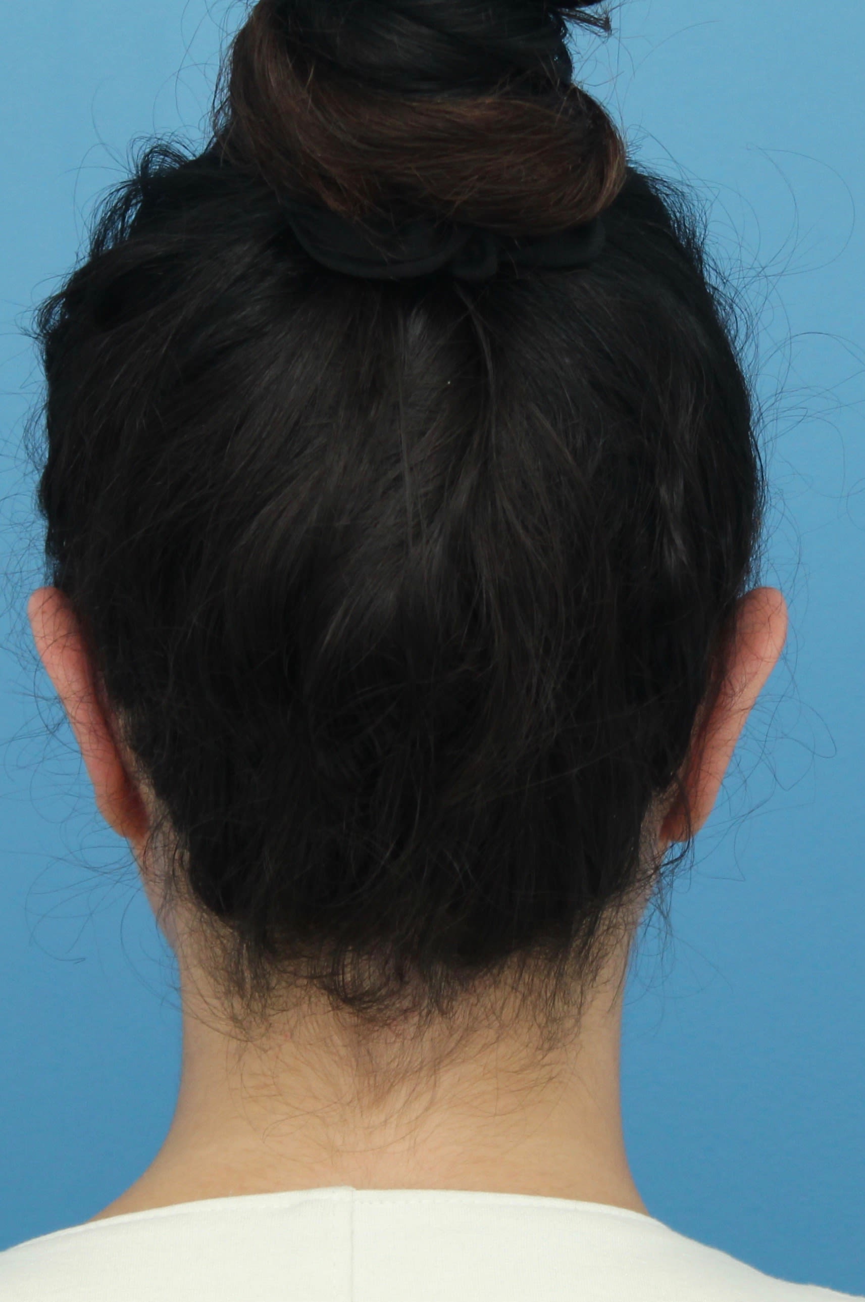 Otoplasty After, Female 31 - 1399