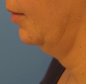 Kybella® Before, Female 52 - 2614
