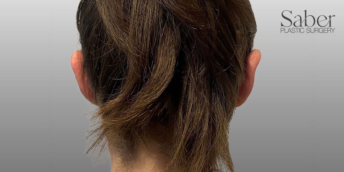 Ear Surgery (Otoplasty) After, Female 44 - 3927