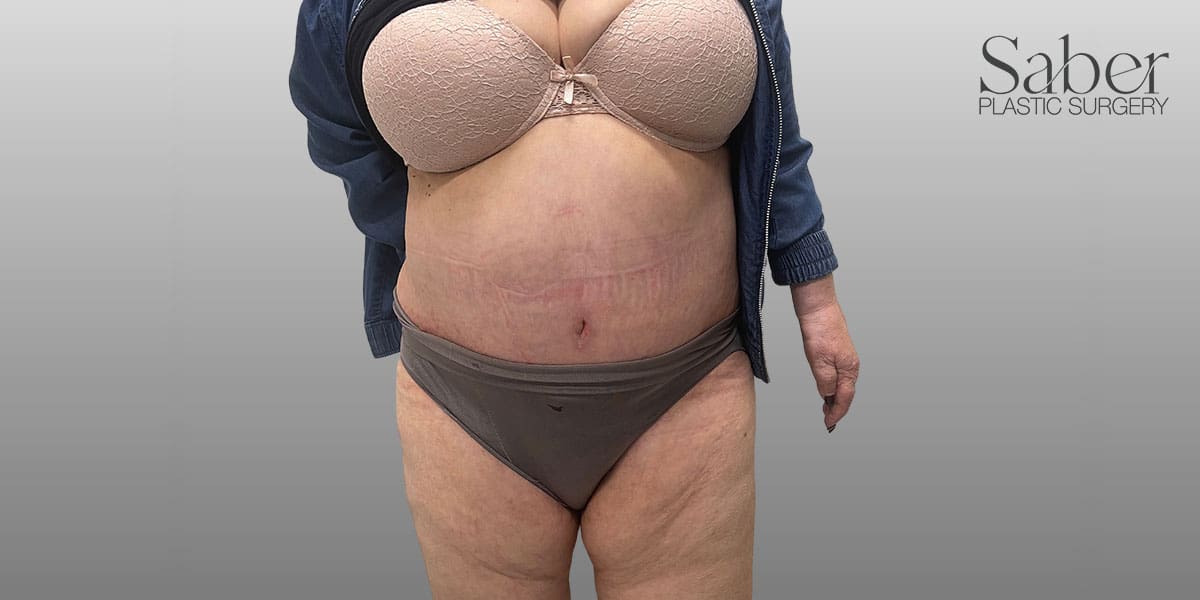 Panniculectomy After, Female 49 - 3946