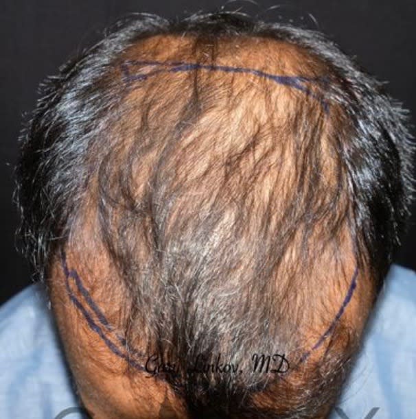 Follicular Unit Extraction Before, Male 41 - 2732