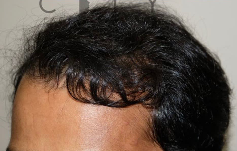 Follicular Unit Extraction After, Male 41 - 2733