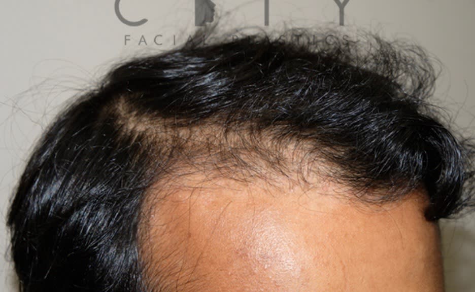 Follicular Unit Extraction After, Male 41 - 2734