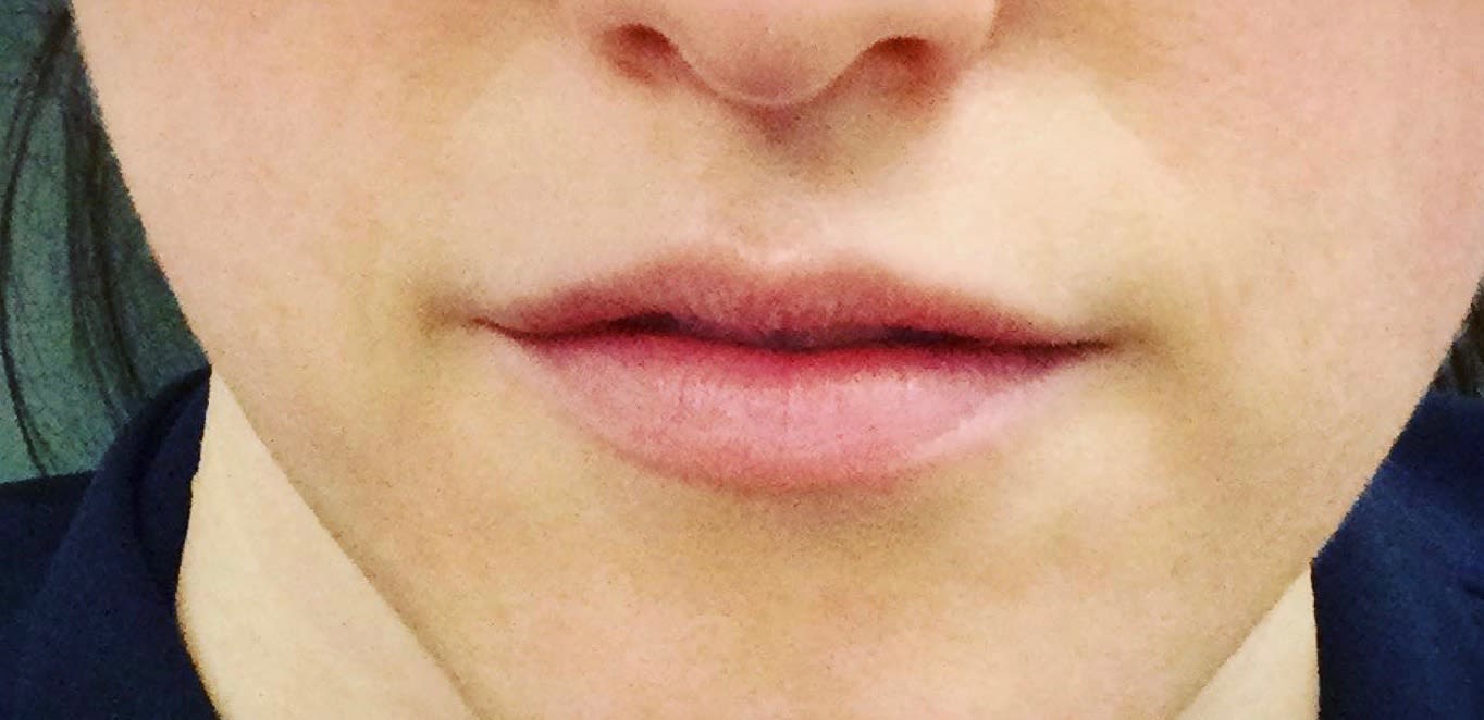 Lip Augmentation and Injections Before, Female 23 - 1832