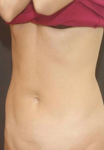 Liposuction After, Female 31 - 2033