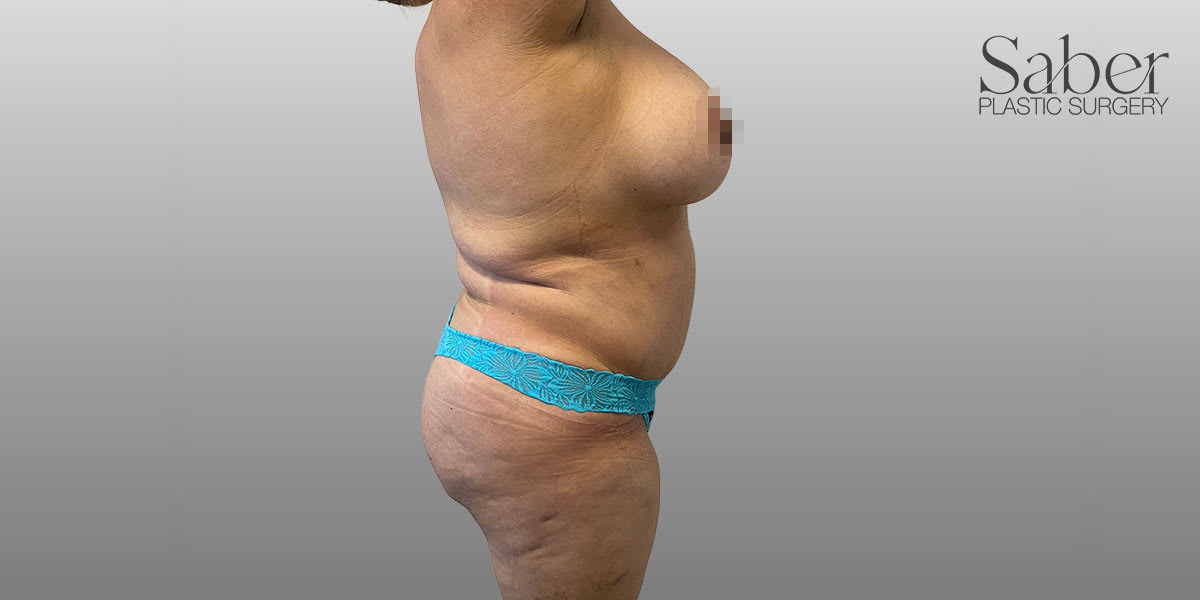 Mommy Makeover Solutions After, Female 45 - 3943