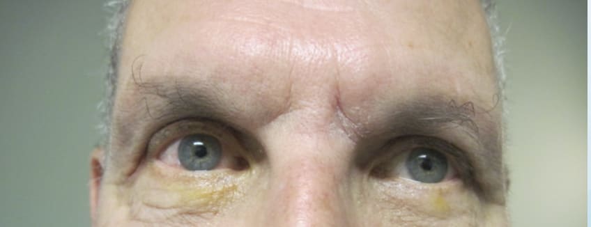 Eyelid Correction Solutions Before, Male 56 - 3834