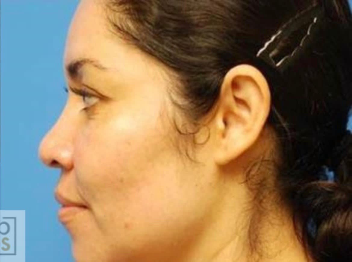 Acne Scar Treatment: Dermabrasion After, Female 36 - 1965