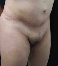 Monsplasty Before, Female 42 - 2461