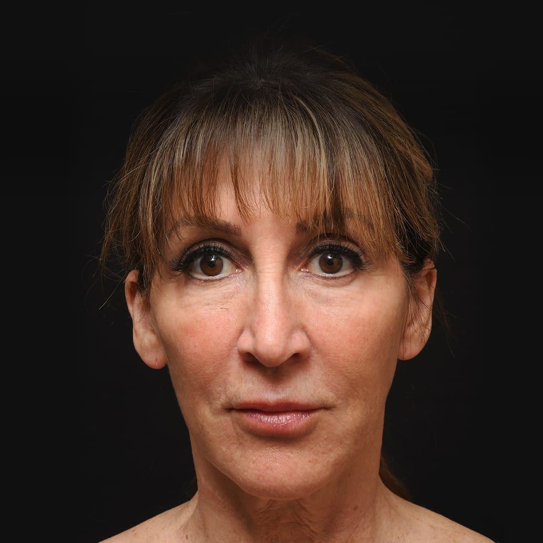 Facelift After, Female 55 - 60