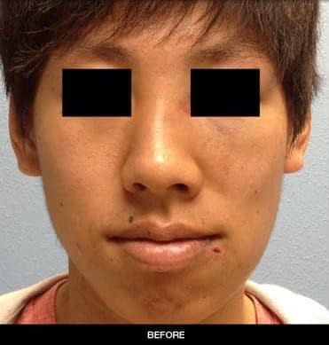 Nose Augmentation & Nose Reduction Solutions Before, Male 22 - 2458